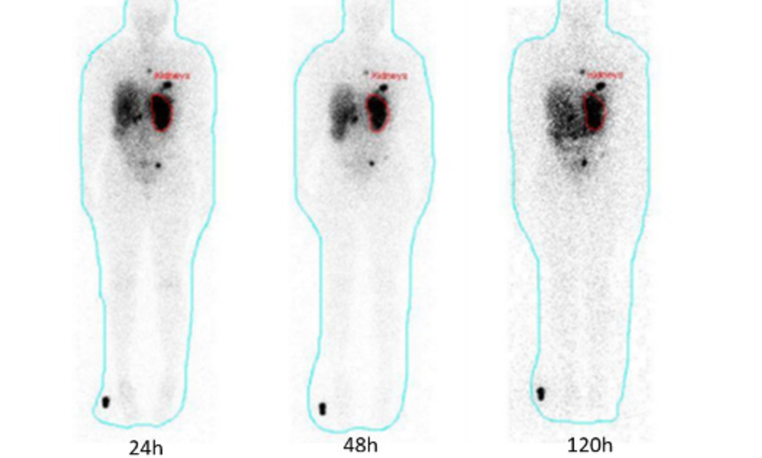 Evaluación de las funciones renales utilizando Dosimetry Toolkit para el tratamiento de un tumor neuroendocrino metastásico en un paciente con un único riñón.