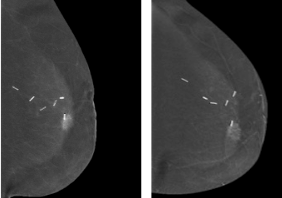 Experiencia del Centro Regional de Diagnóstico de Mama del Hospital Las Higueras de Talcahuano en la realización de biopsias estereotácticas con contraste utilizando Serena Bright.