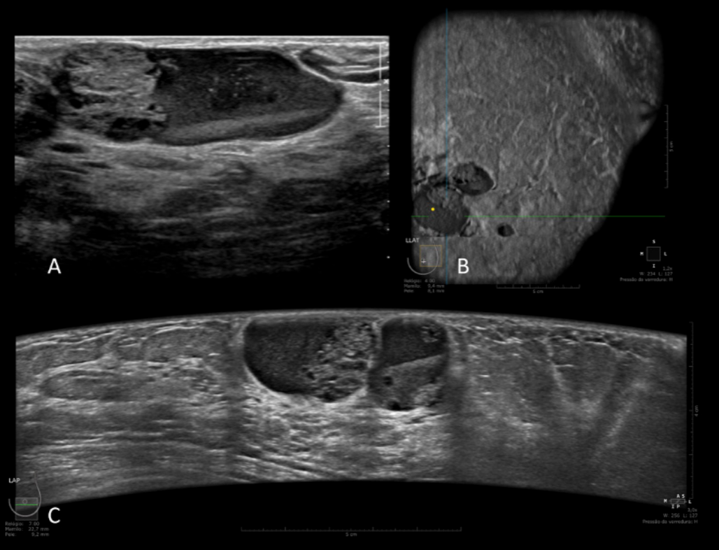 Automated Breast Ultrasound (ABUS): una tecnología innovadora y diferenciada en la evaluación de mamas densas para la detección de cáncer.