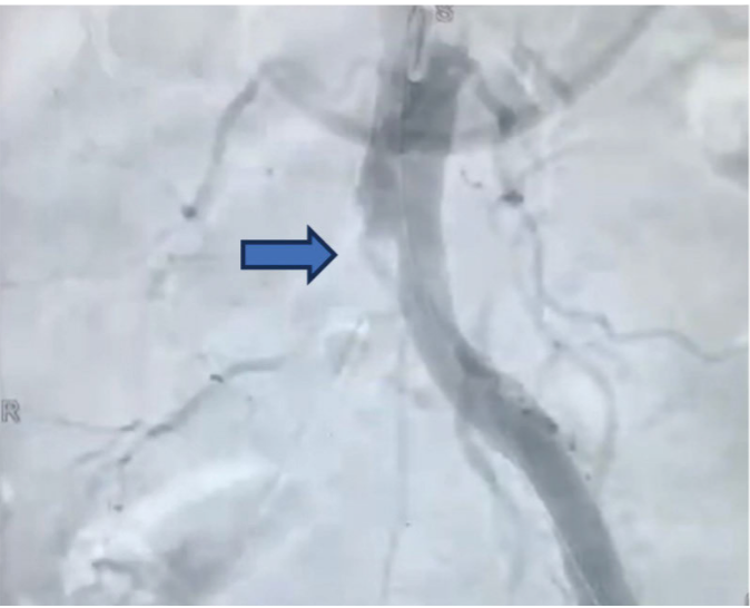 Técnica angiográfica de urgencia con OEC ONE Vascular.
