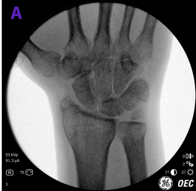 Reconstrucción del ligamento escafolunar, cirugía mínimamente invasiva con OEC Miniview en Clínica Indisa