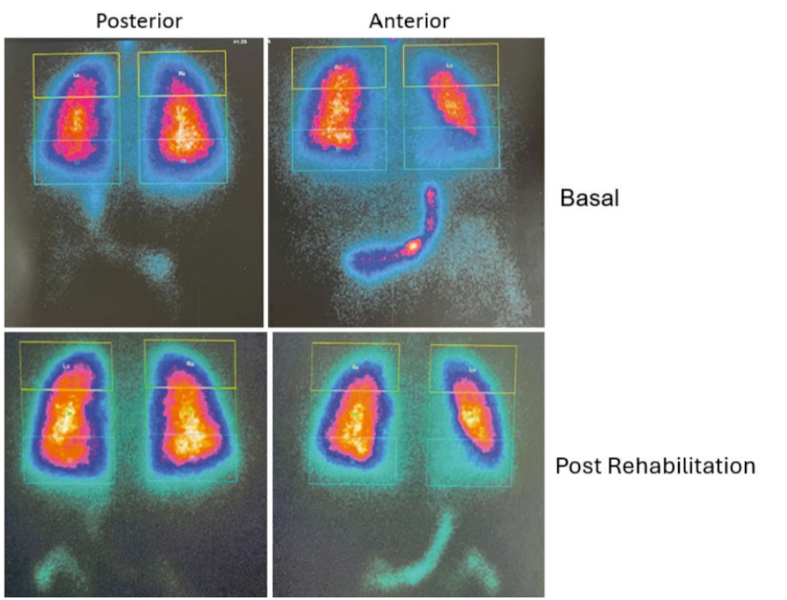 Patients with post-COVID-19 syndrome often present with persistent and diff icult-to-characterize respiratory symptoms, such as dyspnea and fatigue, making diagnosis and clinical follow-up challenging. Pulmonary V/Q scintigraphy using GEʼs SPECT technology provides three-dimensional imaging and precise functional data, enabling the identifi cation of ventilation and perfusion abnormalities even in subtle cases. This approach offers patients a more accurate diagnosis and measurable clinical improvement, while supporting physicians in therapeutic decision-making based on objective evidence.“ Importance of V/Q Scintigraphy in the Diagnosis and Monitoring of Post-COVID-19 Syndrome Using Volumetrix MI